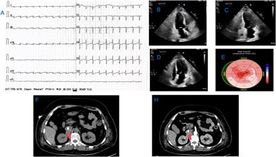 Management of rTTS associated with PGL using VA-ECMO and surgical resection: a case report